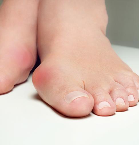 hallux valgus